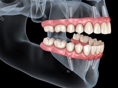 Illustration of All-on-4 dental implants in upper and lower arch