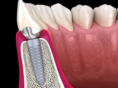 Side-view illustration of dental implant in jawbone