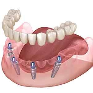 Illustration of lower arch of implant dentures with white background