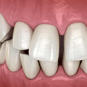 Illustration of gapped teeth