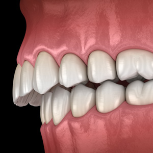Illustration of an overbite