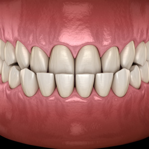 Illustration of an underbite