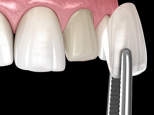 Illustration of veneer being placed on tooth