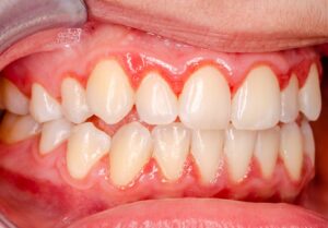 up-close view of red swollen gums